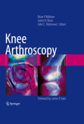 Knee arthroscopy