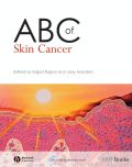 ABC of skin cancer