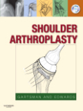 Shoulder arthroplasty