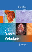 Oral cancer metastasis