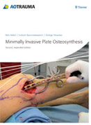 Minimally invasive plate osteosynthesis