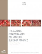 Tratamiento con implantes del maxilar superior atrófico