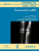 Fracturas de la rodilla