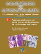 Punción aspiración con aguja fina en el diagnóstico de los tumores de hueso